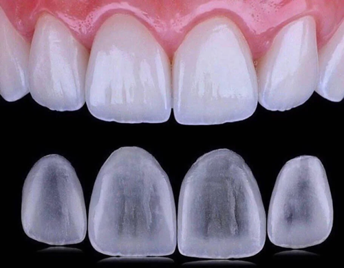 E-Max veneers