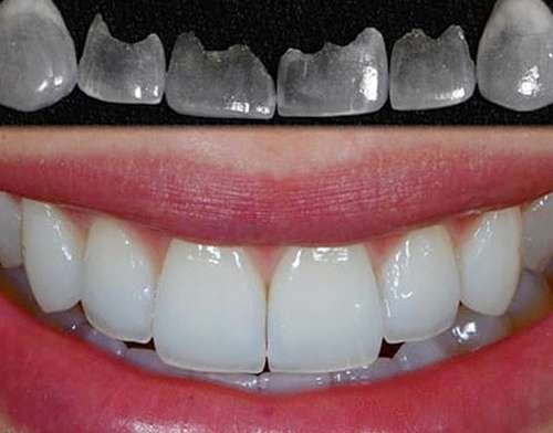 E-Max veneers