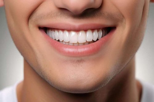 Dental veneers
