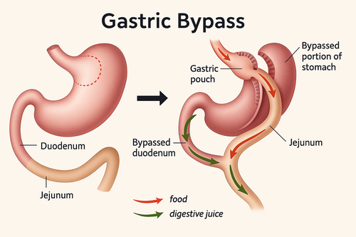 gastric untreating
